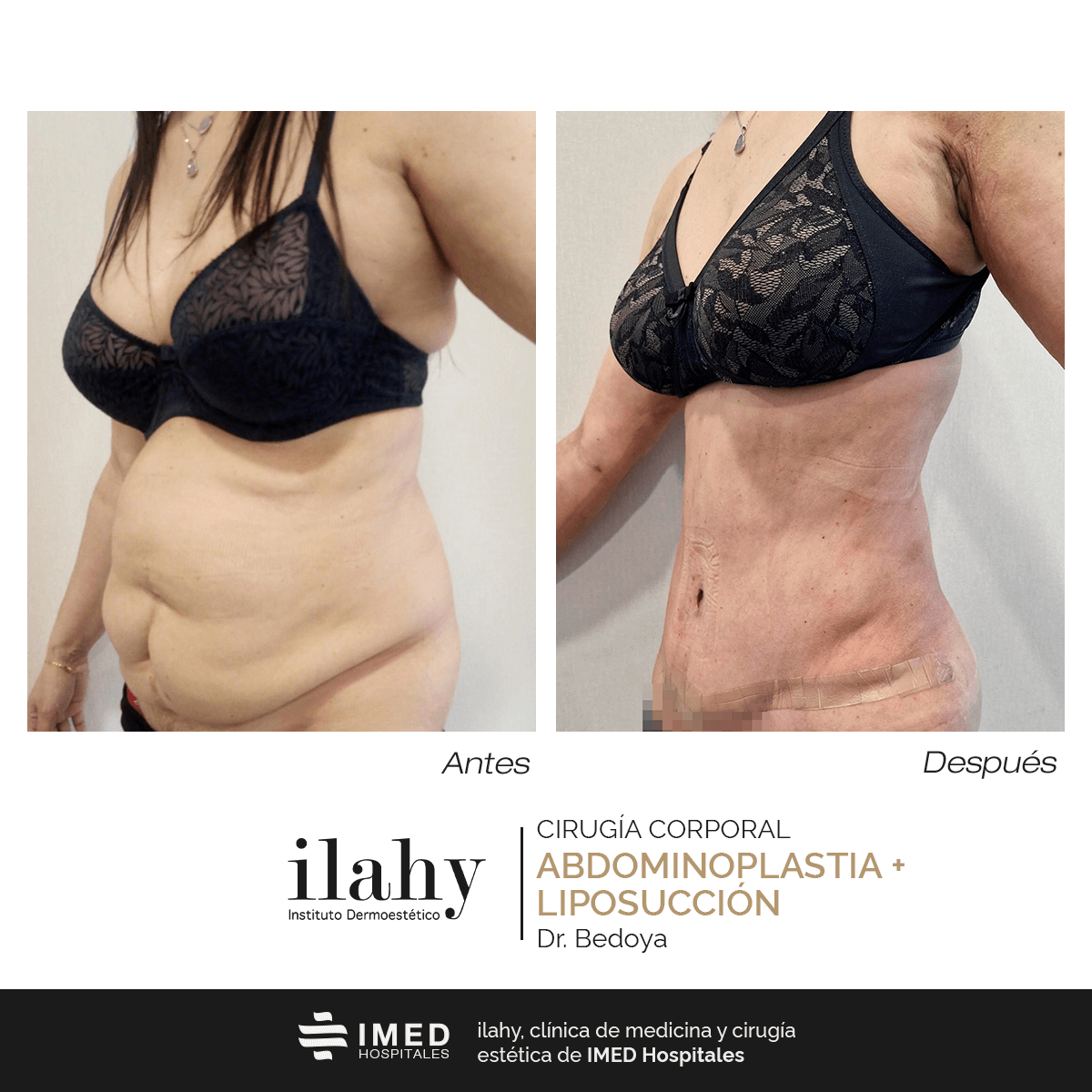 Antes y después de una liposucción en ilahy
