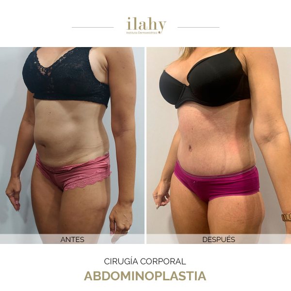 Antes y después de una abdominoplastia en ilahy
