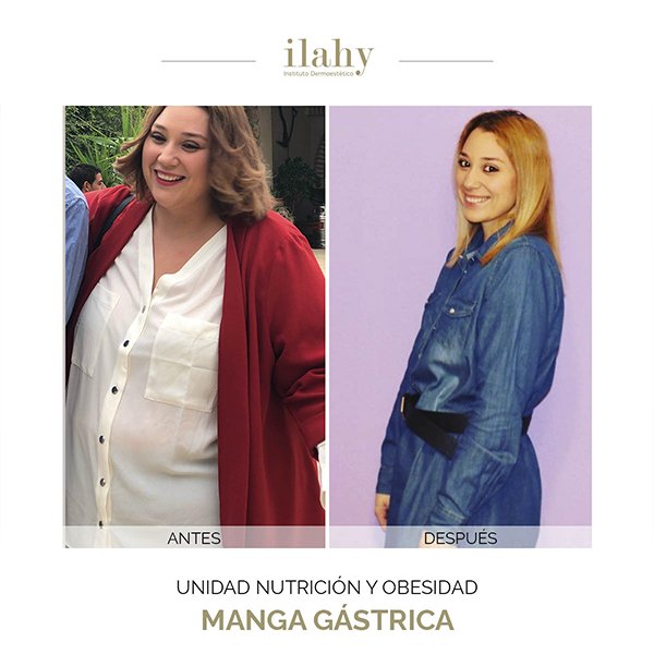 Antes y después de una cirugía bariátrica en ilahy