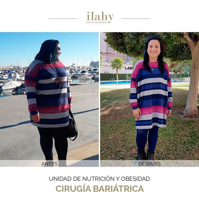 Antes y después de una cirugía bariátrica en ilahy