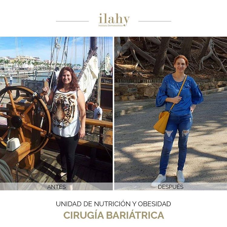 Antes y después de una manga gástrica en ilahy
