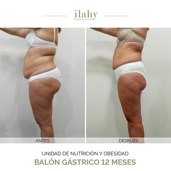 Antes y después de un balón gástrico en ilahy