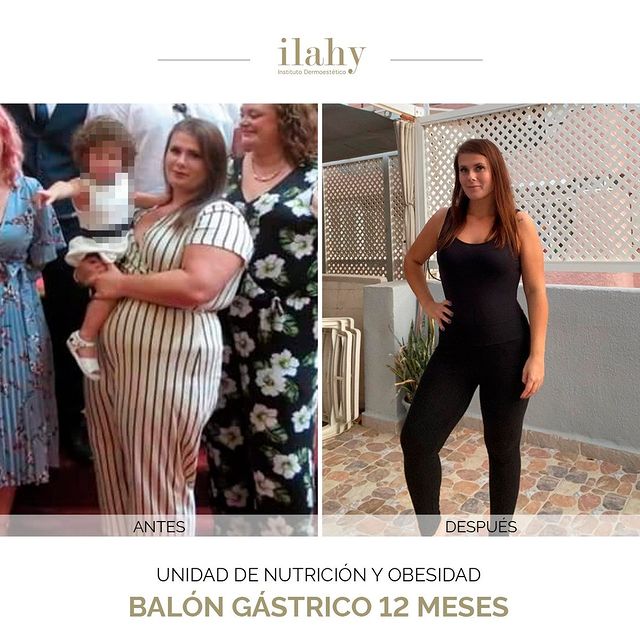 Antes y después de un balón gástrico en ilahy