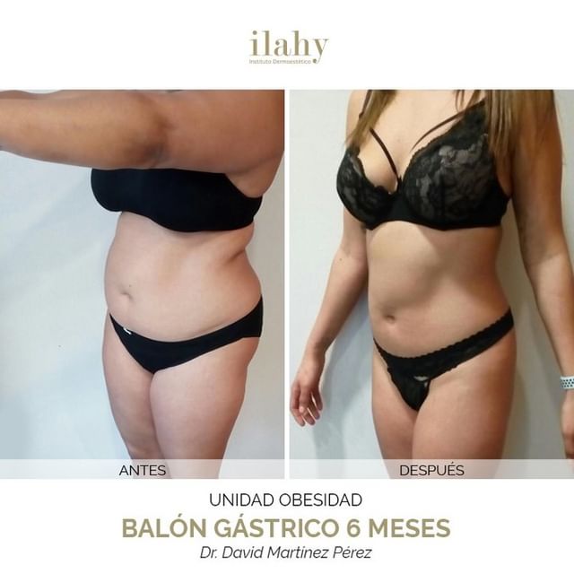 Antes y después de un balón gástrico en ilahy