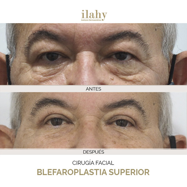 Antes y después de una blefaroplastia en ilahy