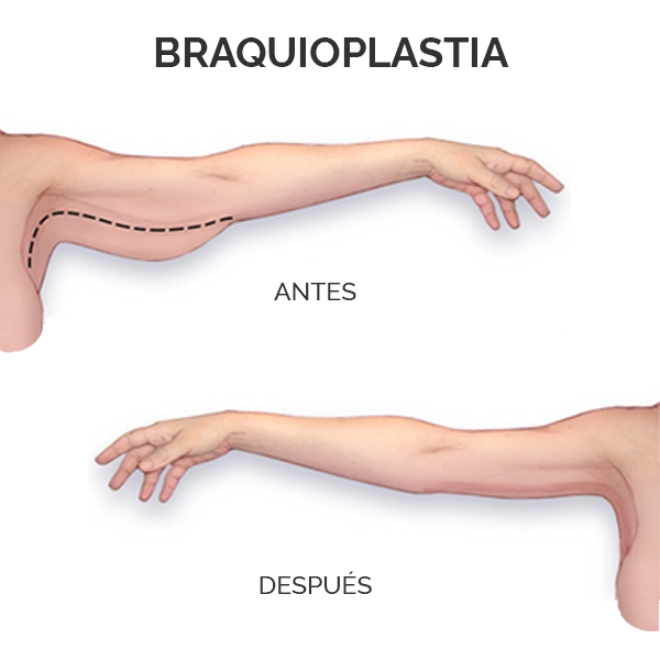 Braquioplastia, el lifting de brazos, en ©ilahy