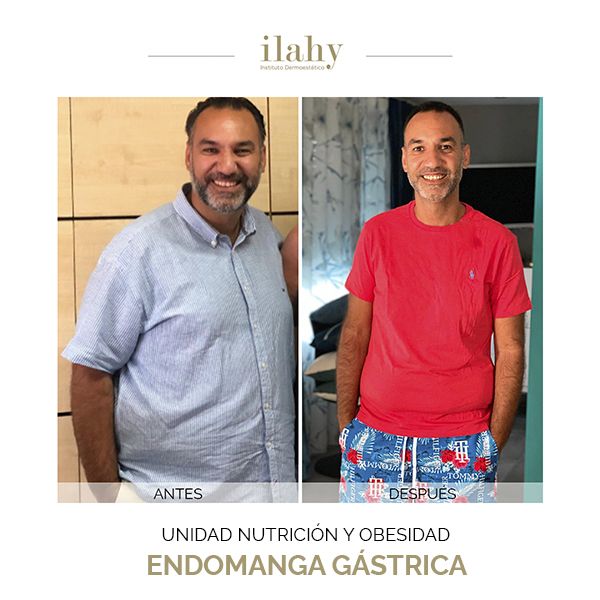 Antes y después de una endomanga gástrica en ilahy