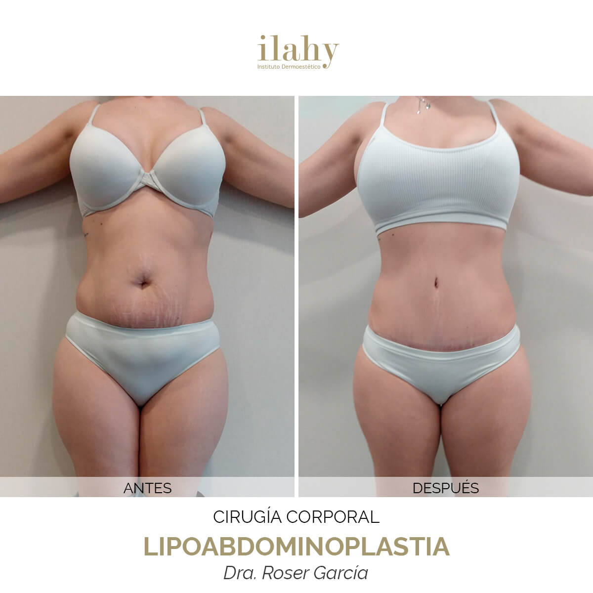 Antes y después de una abdominoplastia en ilahy