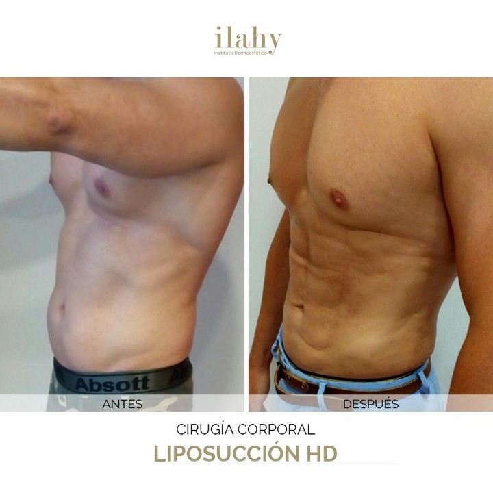 Antes y después de una liposucción en ilahy