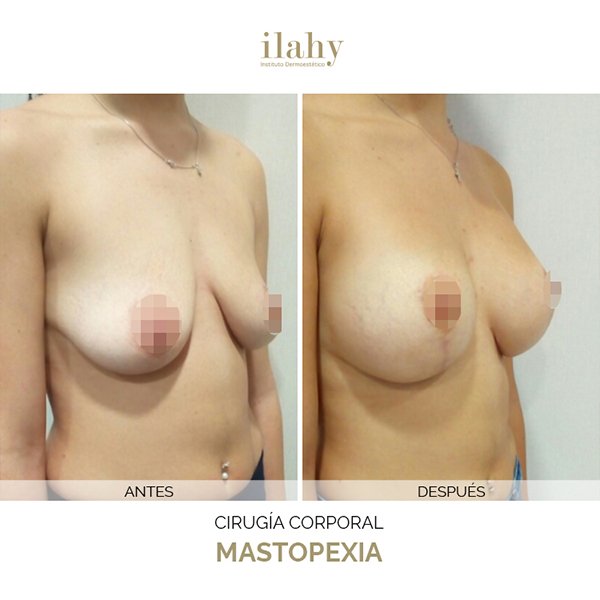 Antes y después de una mastopexia en ilahy