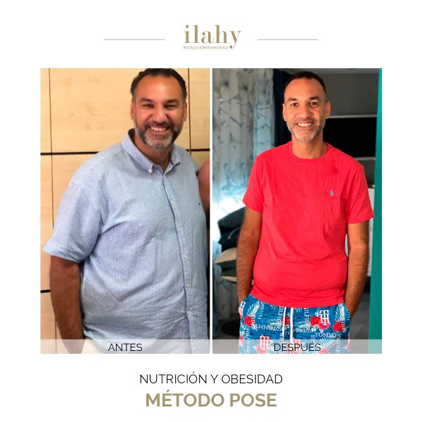 Antes y después de un método pose en ilahy