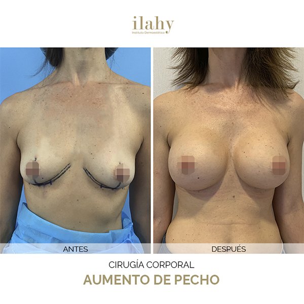 Antes y después de una liposucción en ilahy