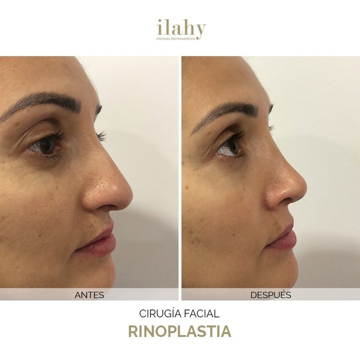 Antes y después de una rinoplastia en ilahy