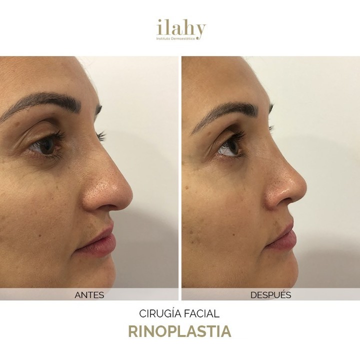 IPL (Luz Pulsada Intensa)  Ilahy Clínicas de Estética