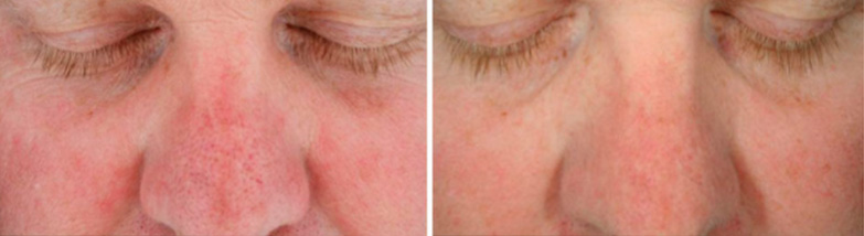 Hydrafacial Antes y después en ilahy