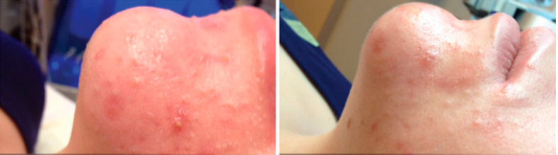Hydrafacial Antes y después en ilahy