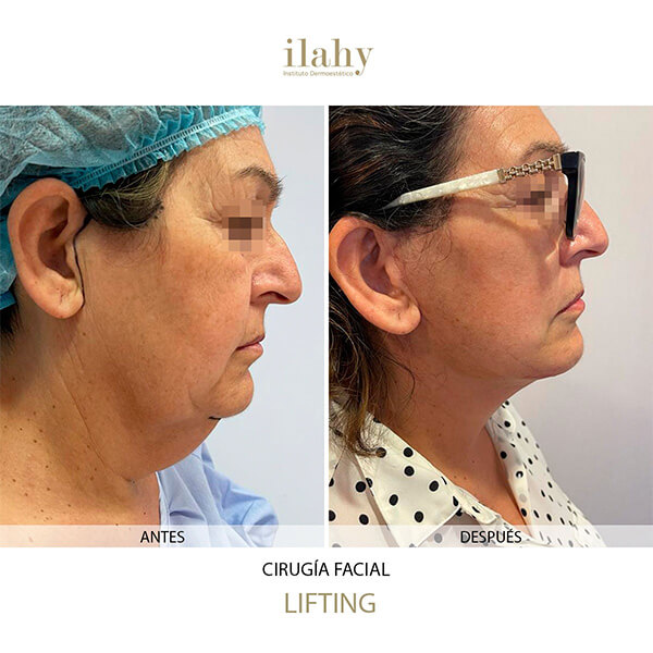 Antes y después de una blefaroplastia en ilahy