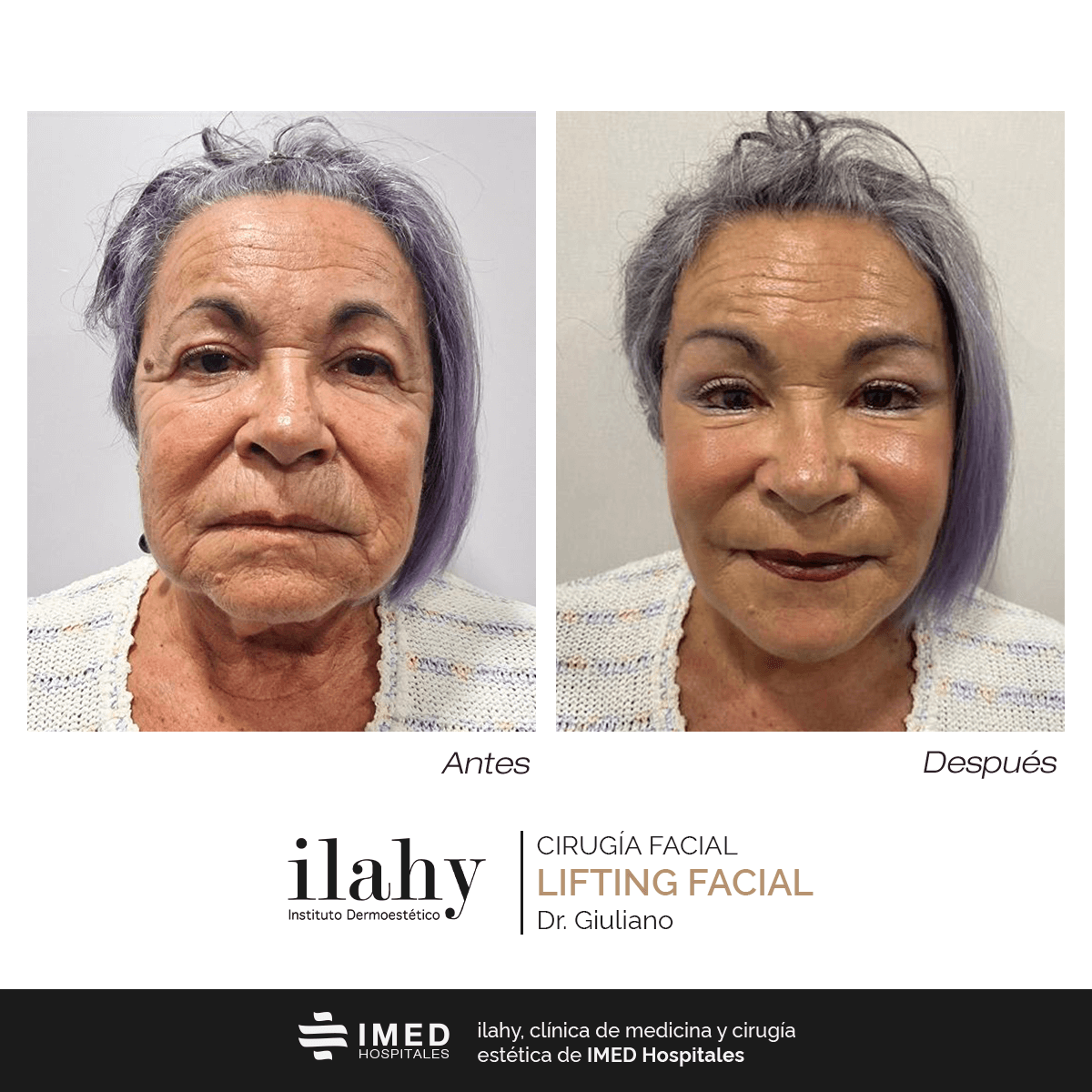 Antes y después de una liposucción en ilahy