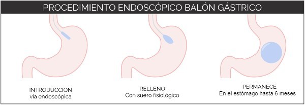 cómo funciona un balón gástrico