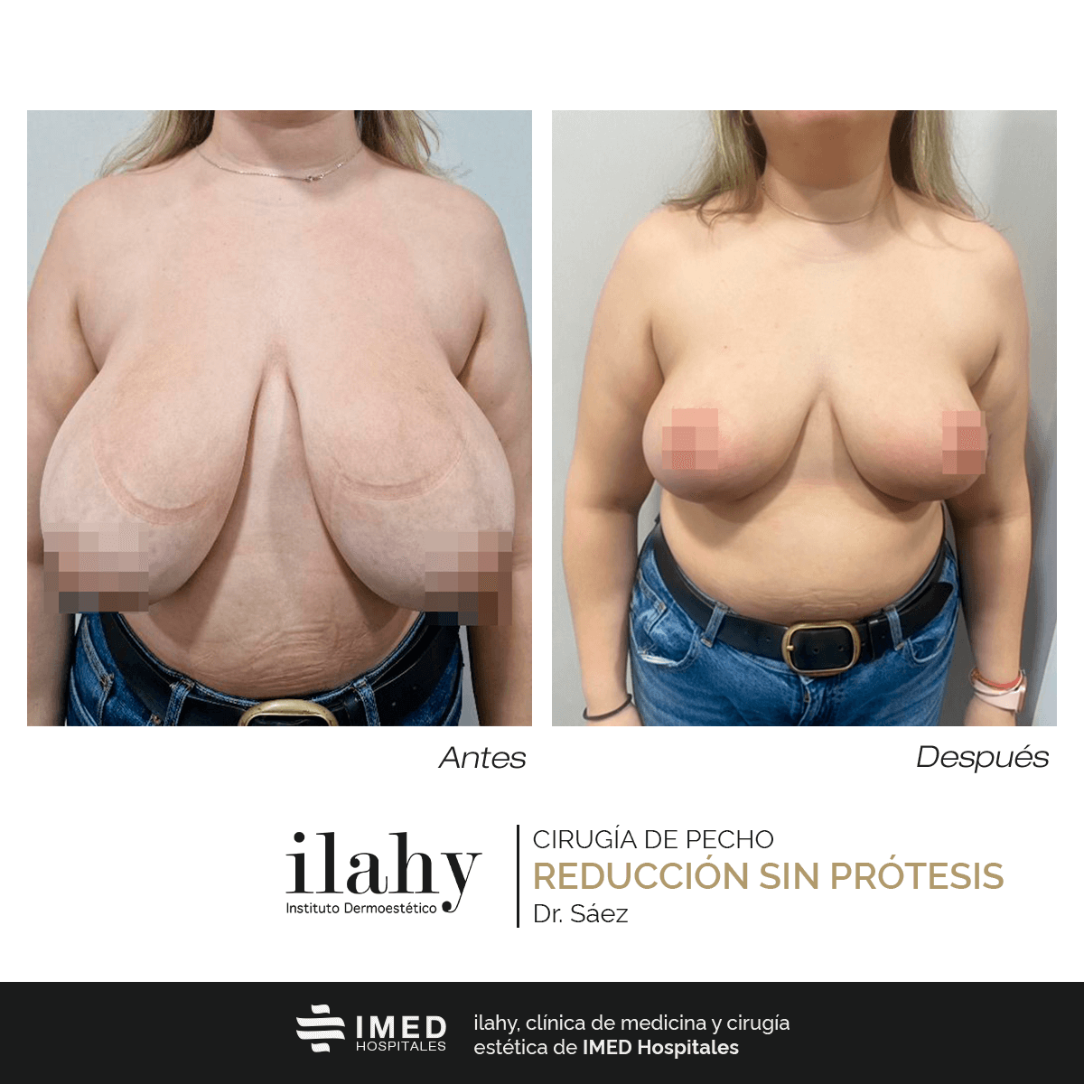 Antes y después de una mastopexia en ilahy