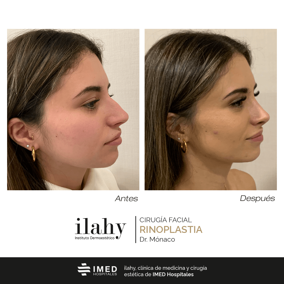 Antes y después de un método pose en ilahy